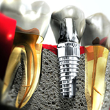 Conventional Dental Implant